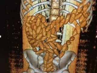 Midesinde uyuşturucuyla yakalanan zanlı tutuklandı